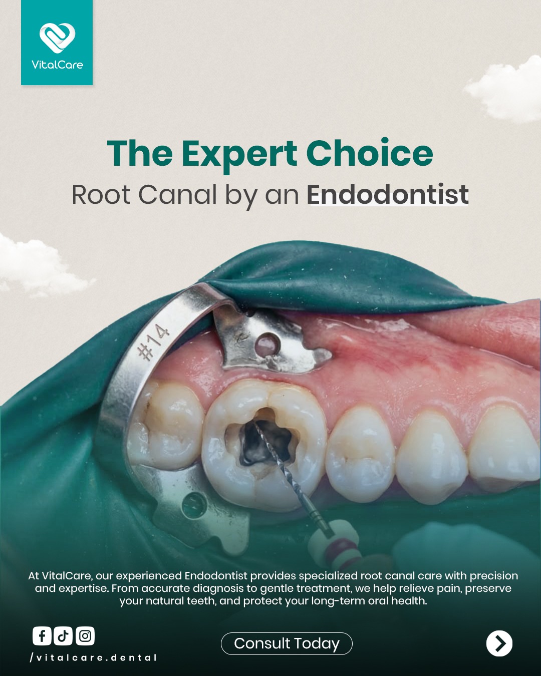 Root canal treatment in Maldives by Dr. Giftlin Denny Xavier at