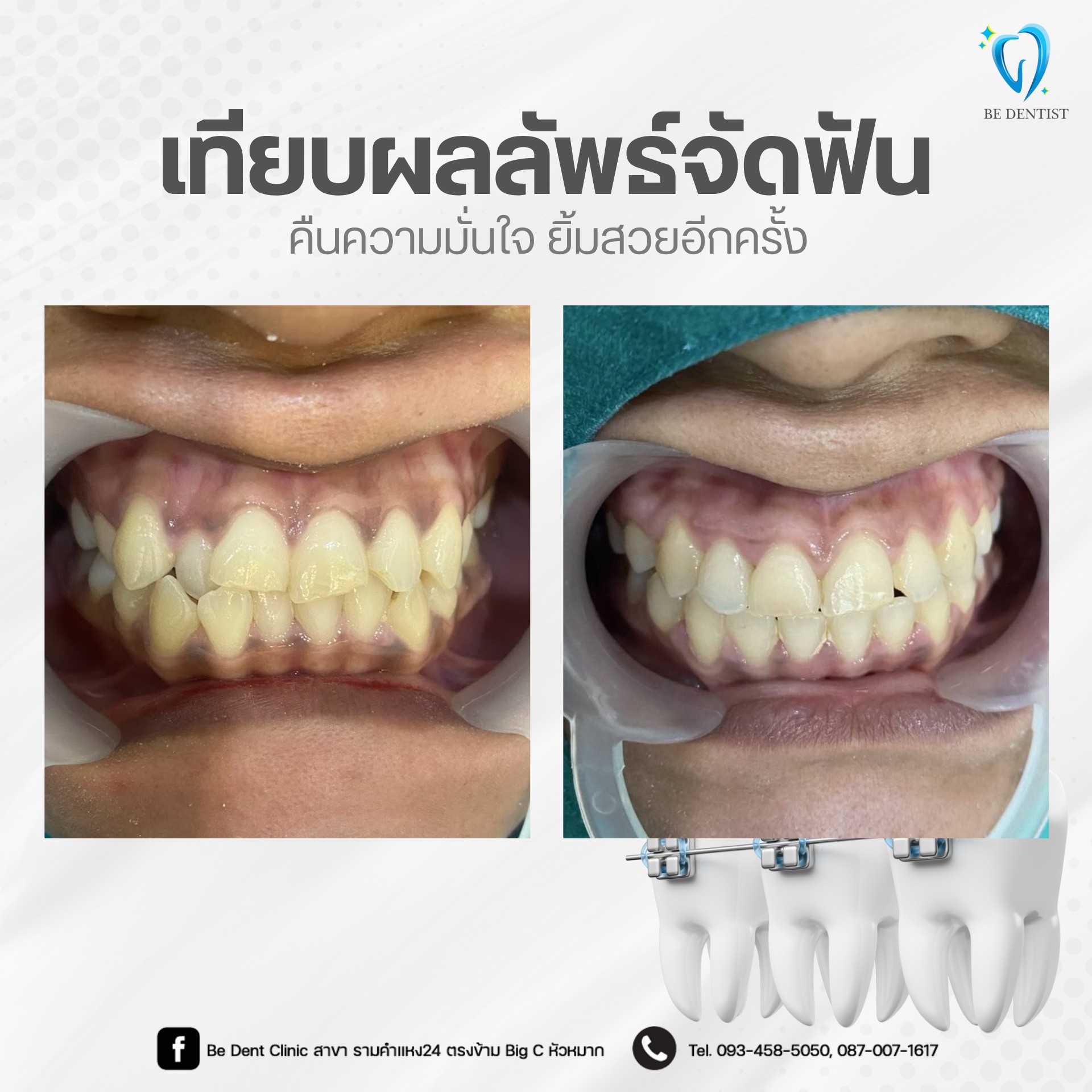 The Best - ใคร มี เขี้ยว🧛‍♀️...ฟันซ้อนเก เศษอาหรติดบ่อย สบฟันล่างคร่อม ...