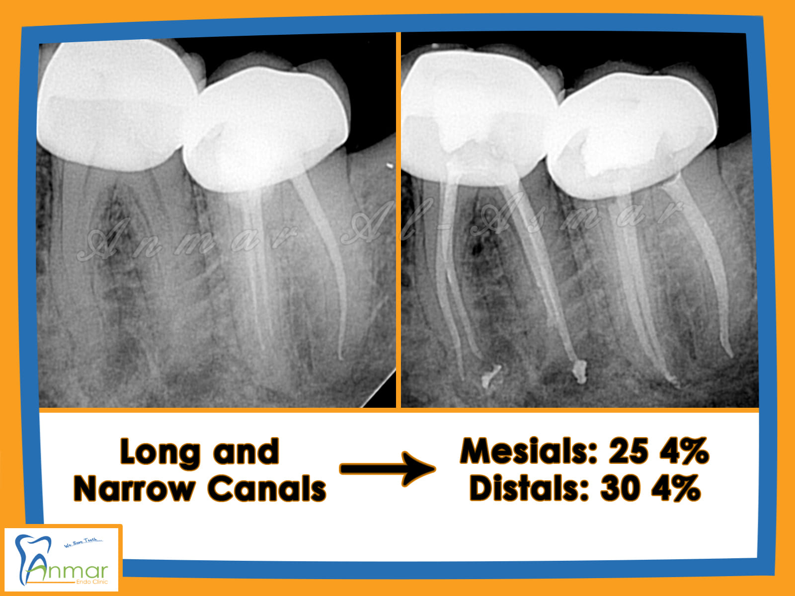 >> Cases with long and... - Dr. Anmar Al-Asmar Endo Clinic