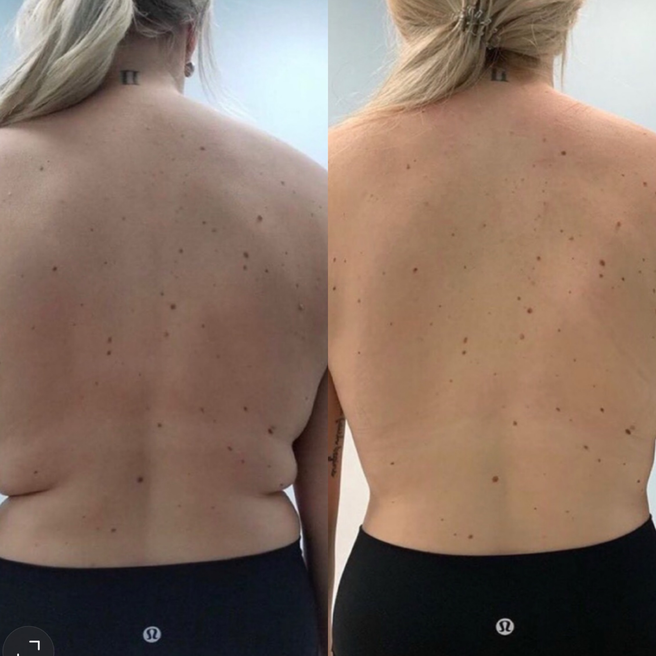can lipo-c be injected subcutaneously How to Give a Subcutaneous Injection is lipo c subq or