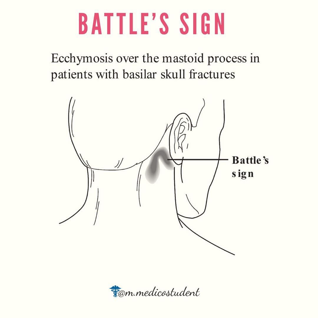 Physiotherapy - A Battle sign, or Battle's sign, is a...