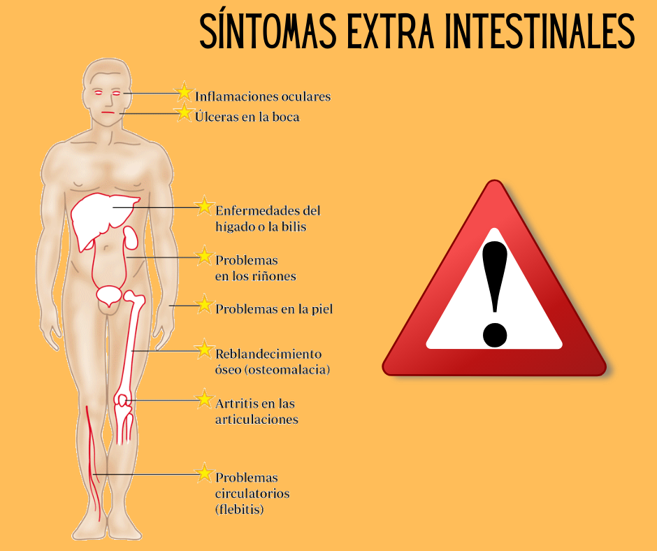 Alive - Síntomas intestinales de la Colitis Los síntomas de la colitis ...