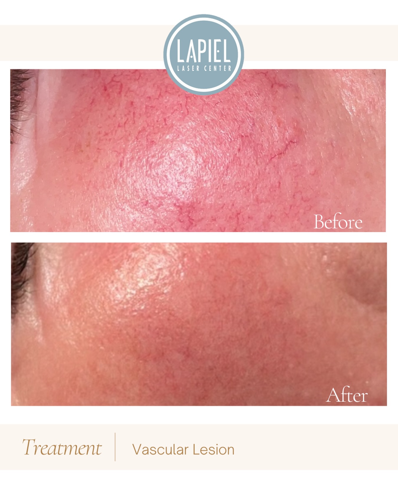 Lapiel Laser Center | Chicago IL