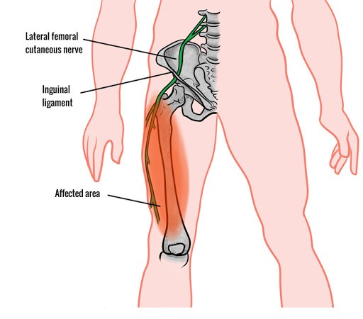 Meralgia paresthetica is caused by compression of the lateral femoral cutaneous nerve, leading to numbness, burning, or tingling over the anterolateral thigh without motor deficits. Diagnosis is primarily clinical, based on characteristic