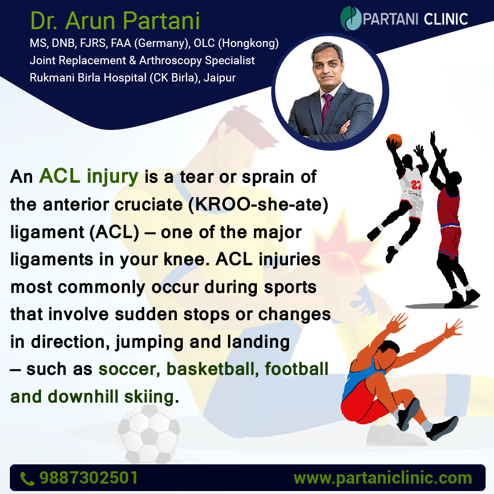 Partani Clinic - 🦵An #ACLinjury is a tear or sprain of the...
