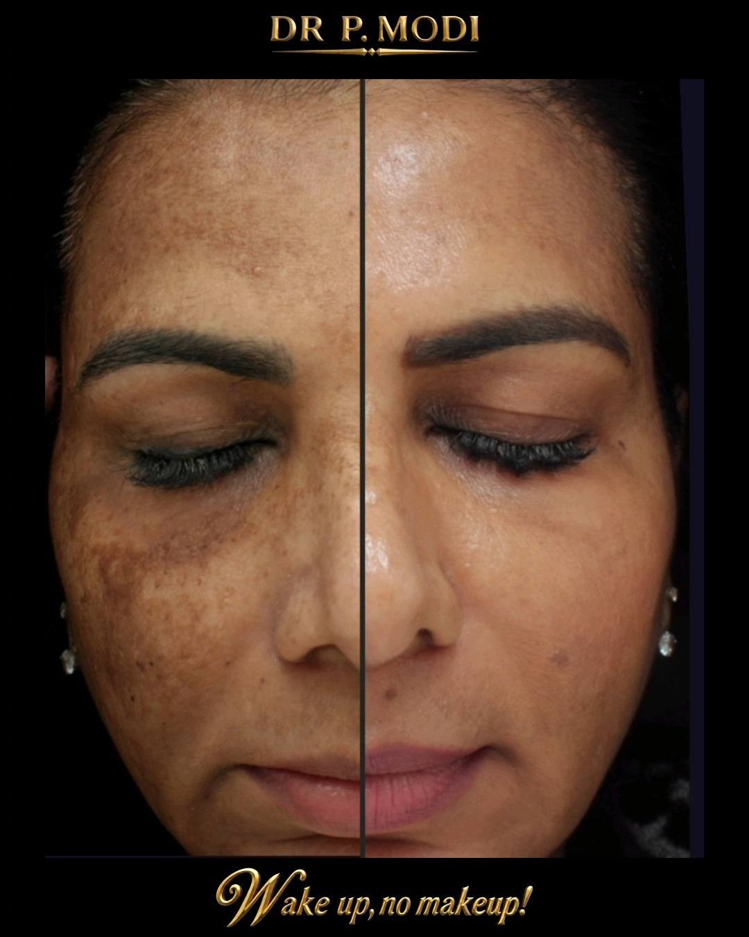 glutathione skin lightening modi Dr - Beyonce Glutathione Restoration Improves Hallmarks