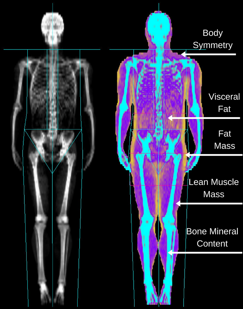 What is a DEXA Scan? DEXA... - River City Imaging Centers | Facebook