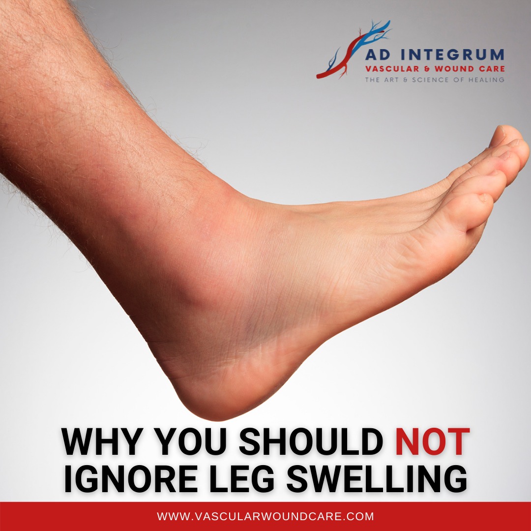 Ad - Leg Swelling (oedema) can be caused by several reasons. 👉It is not ...