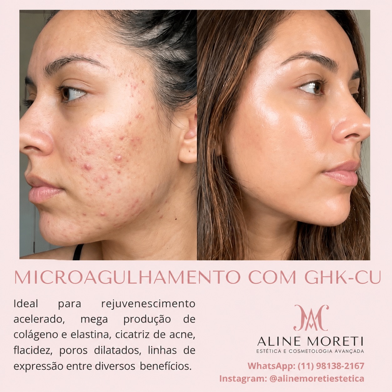 ghk-cu antes e depois Quer dar um “up” na pele combater os sinais do tempo? ✨ O Microagulhamento com é a solução perfeita para uma mega produção de colágeno! Dê uma olhada nessa evolução! GHK-Cu for Research | skin type_sensitive Starter Package Option:Wellness Visit Only
