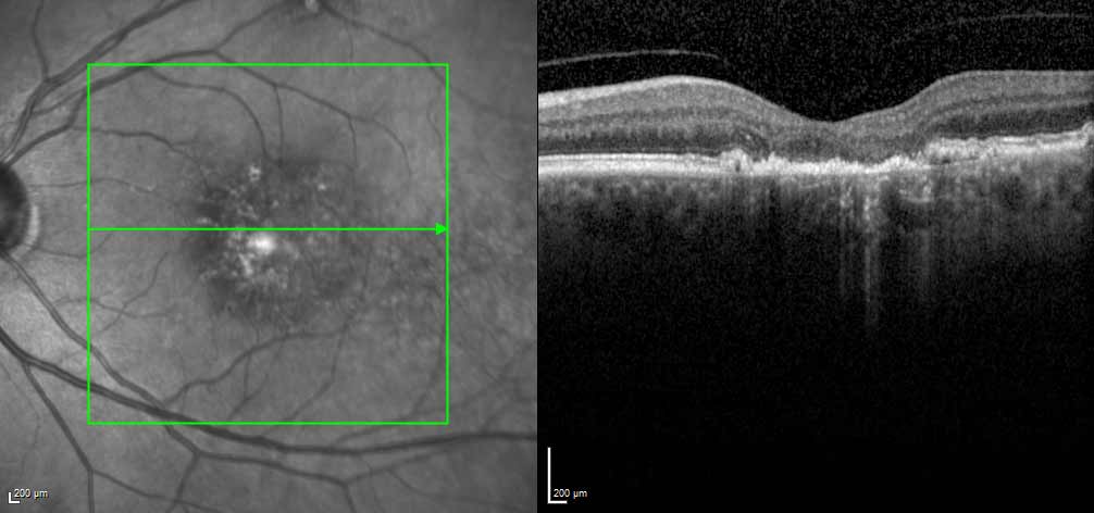 tirzepatide blurry vision and issues with 👀 Can Ozempic affect your eyes? Yes — some people may notice changes A major study published in – Can Tirzepatide Cause Blindness? What