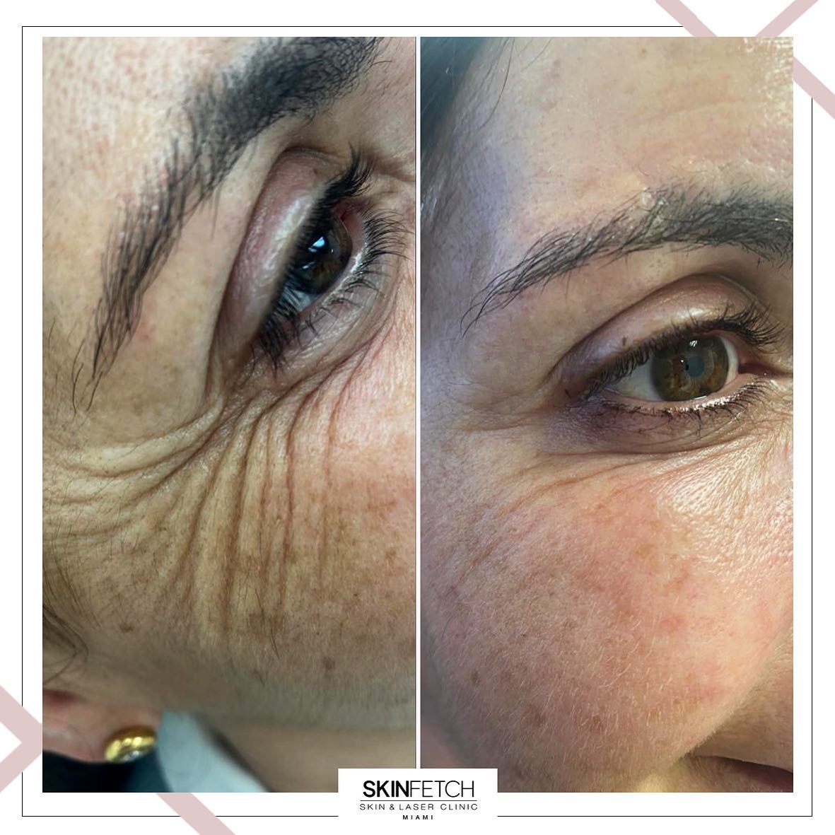 Skinfetch miami - Estimula el colágeno y rejuvenece tu...