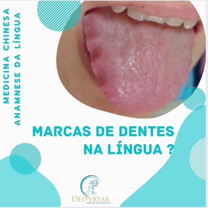 Terapia /Acupuntura/Florais - Língua com Marcas de Dentes: A língua com ...