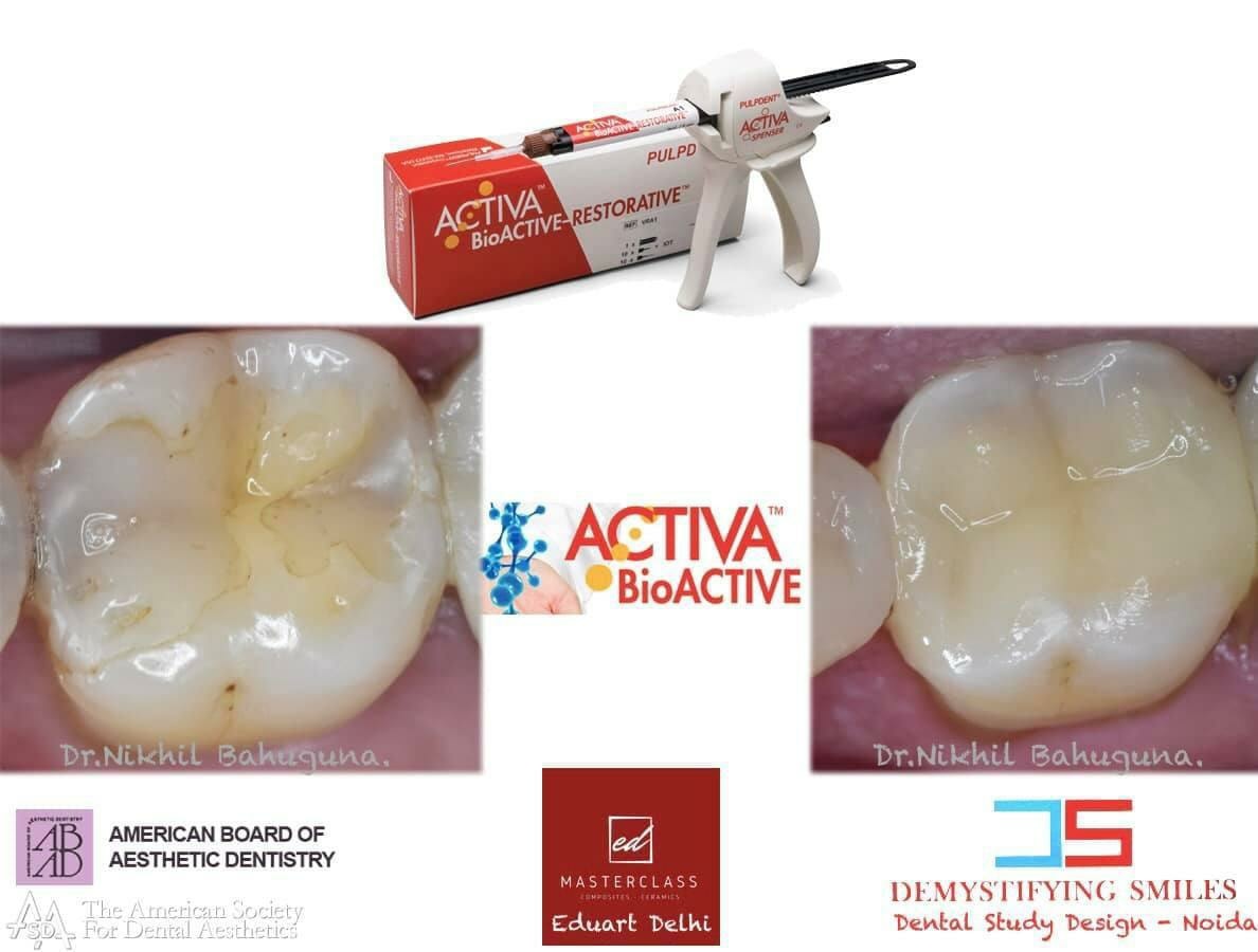 MMdental - A perfect indication for Bioactiva in a failing... | Facebook
