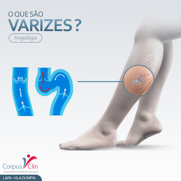 Corpus Clin - O QUE SÃO VARIZES? #Varizes são #veias... | Facebook