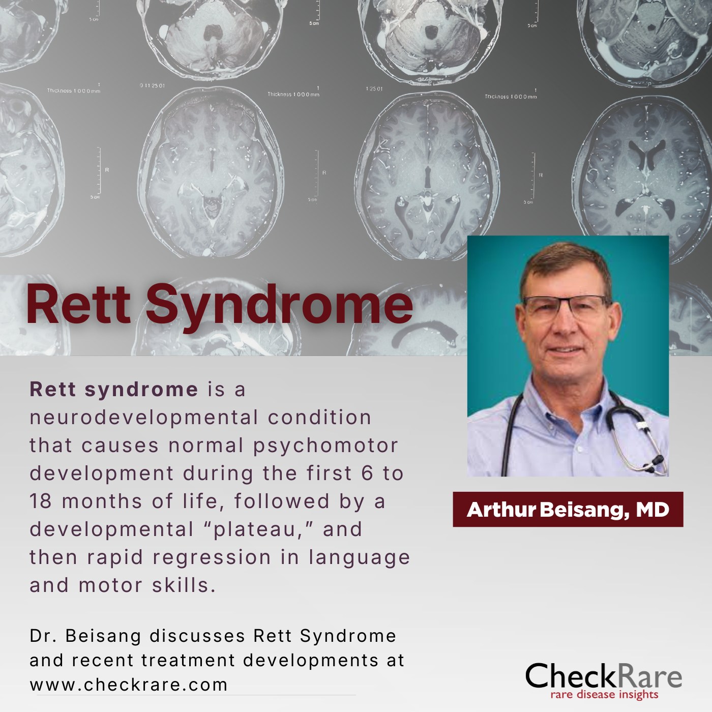 l-carnitine rett syndrome D-serine supplement improves neuronal function in atypical Healing starts at the Chirositolo Strength:10mg