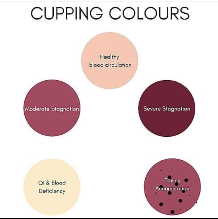 La Cupping Therapy 🌿 Depuis la... - Marine Henry Acupuncture | Facebook