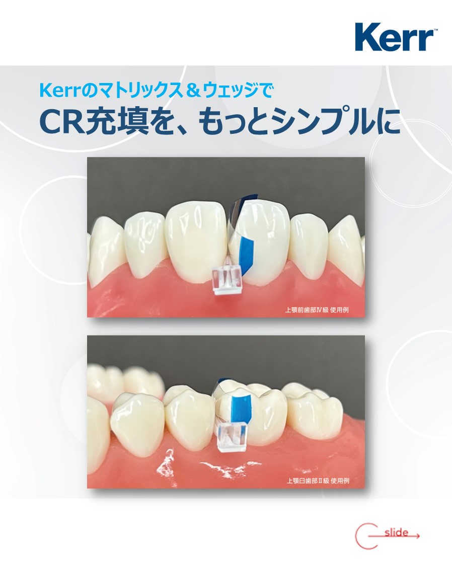 Kerrのマトリックス、ウェッジは操作性に優れ、前歯から臼歯まで幅広い