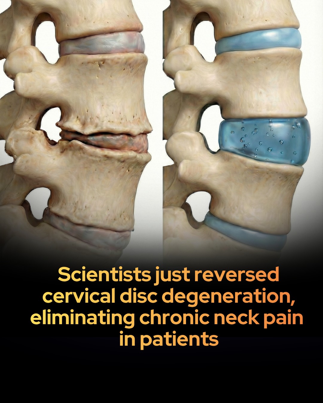 Bpc-157 injections help with degenerative disc disease