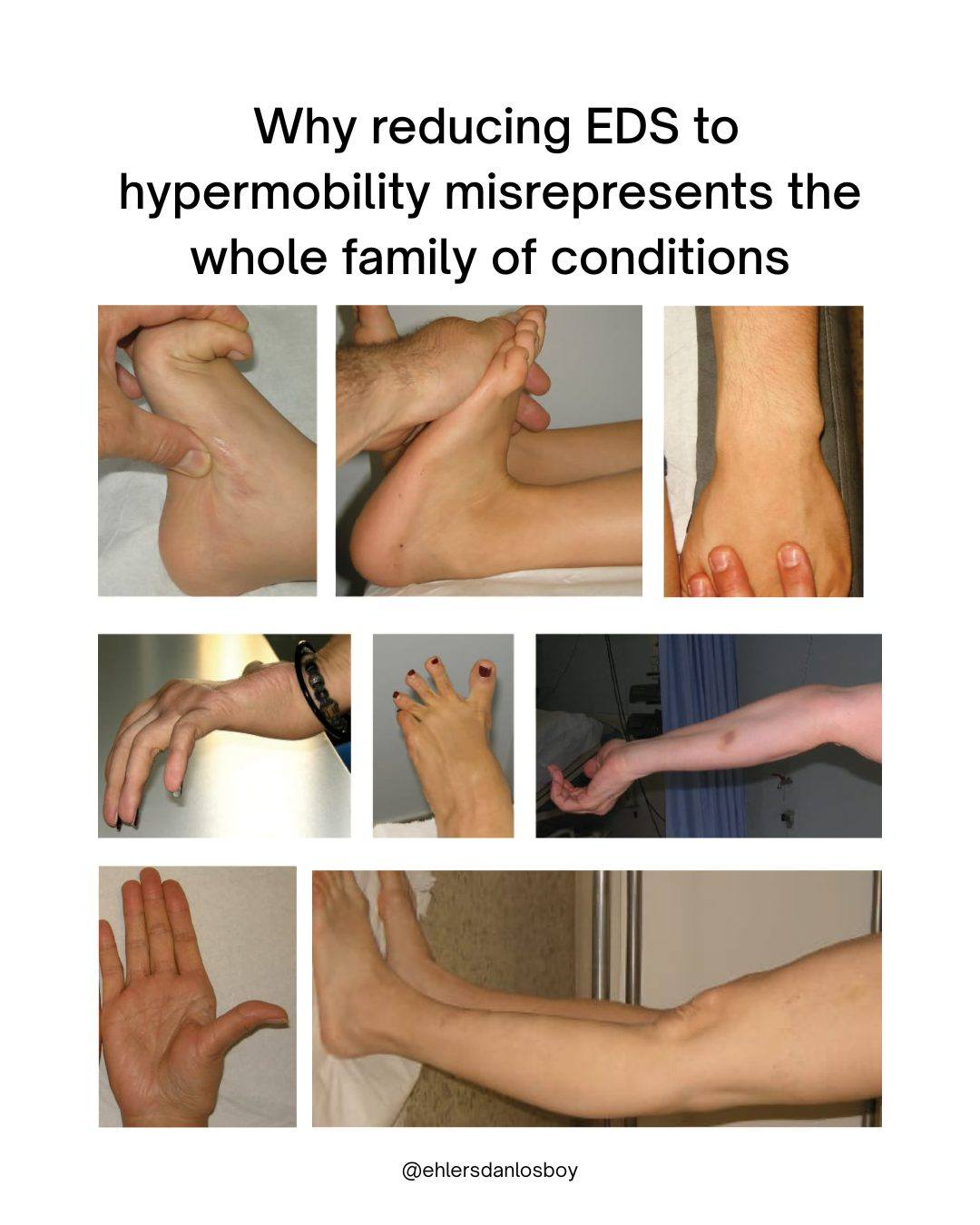 glutathione ehlers-danlos What are the types of syndromes? Can you take a Sun Tan Nos:Pack of 2