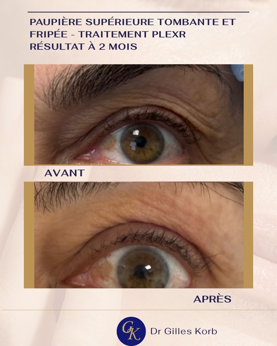 Sitemapcdatahttpwwwmixel Thicoipeinfopatch Paupiere Tombante Sephora