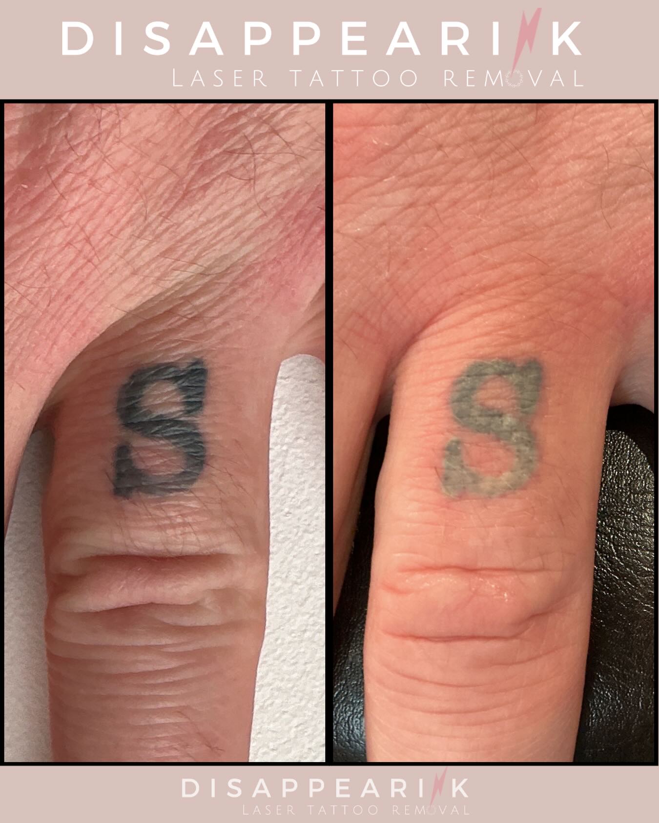 Immediately after a session you'll probably see some whitening / frosting. (🧁 not that kind) this usually goes down in a short time, and your tattoo can tend to look slightly darker