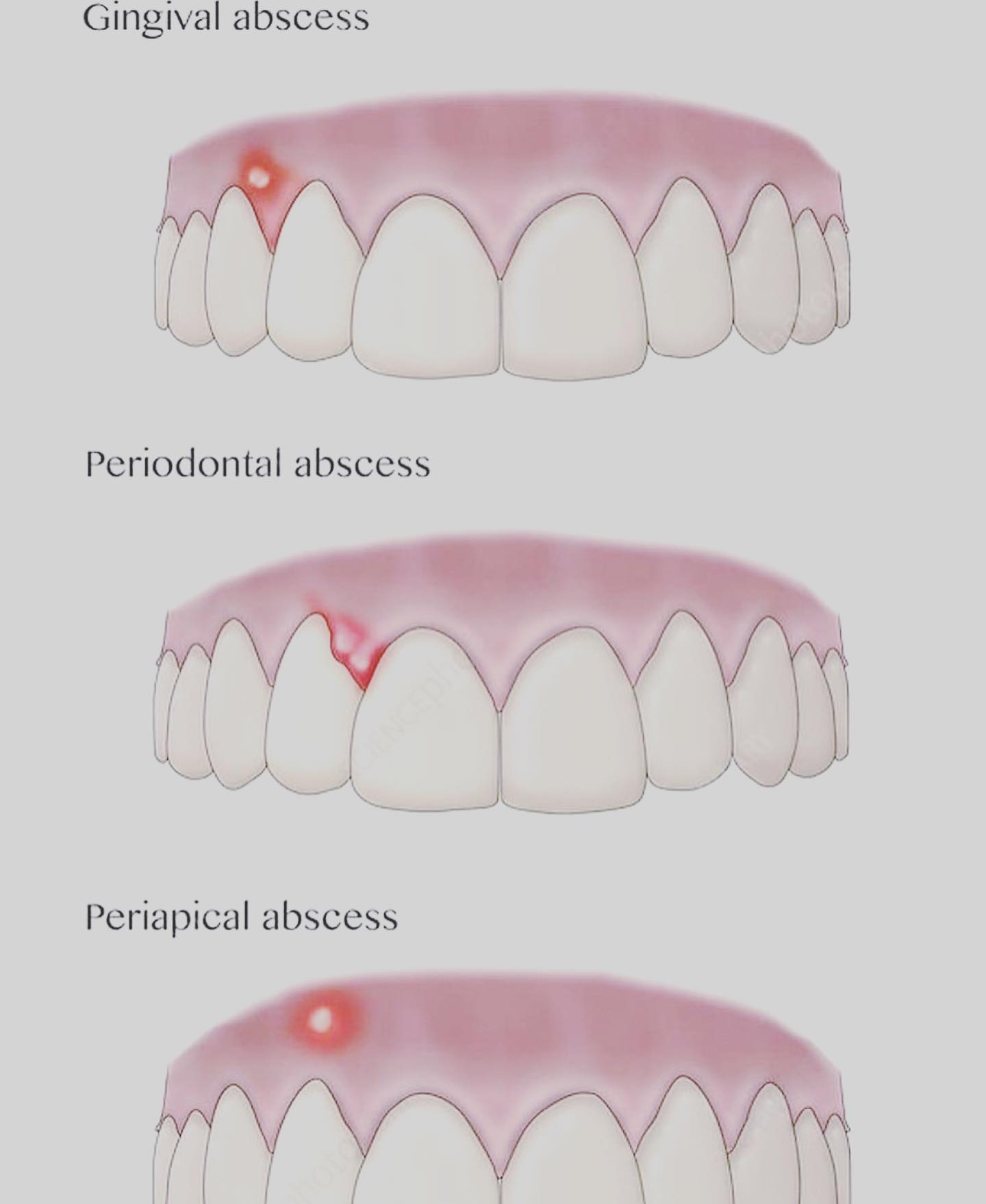 Dr.Mfs Llanes - Types of Dental abscess🦷 | Facebook