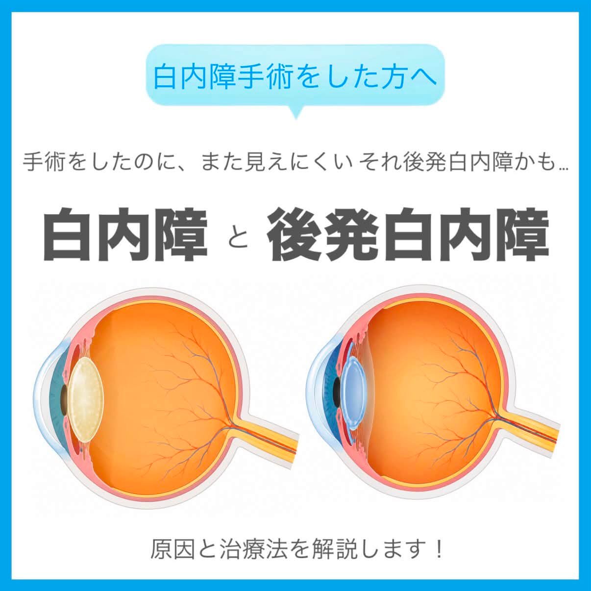 白内障 緑内障 違い