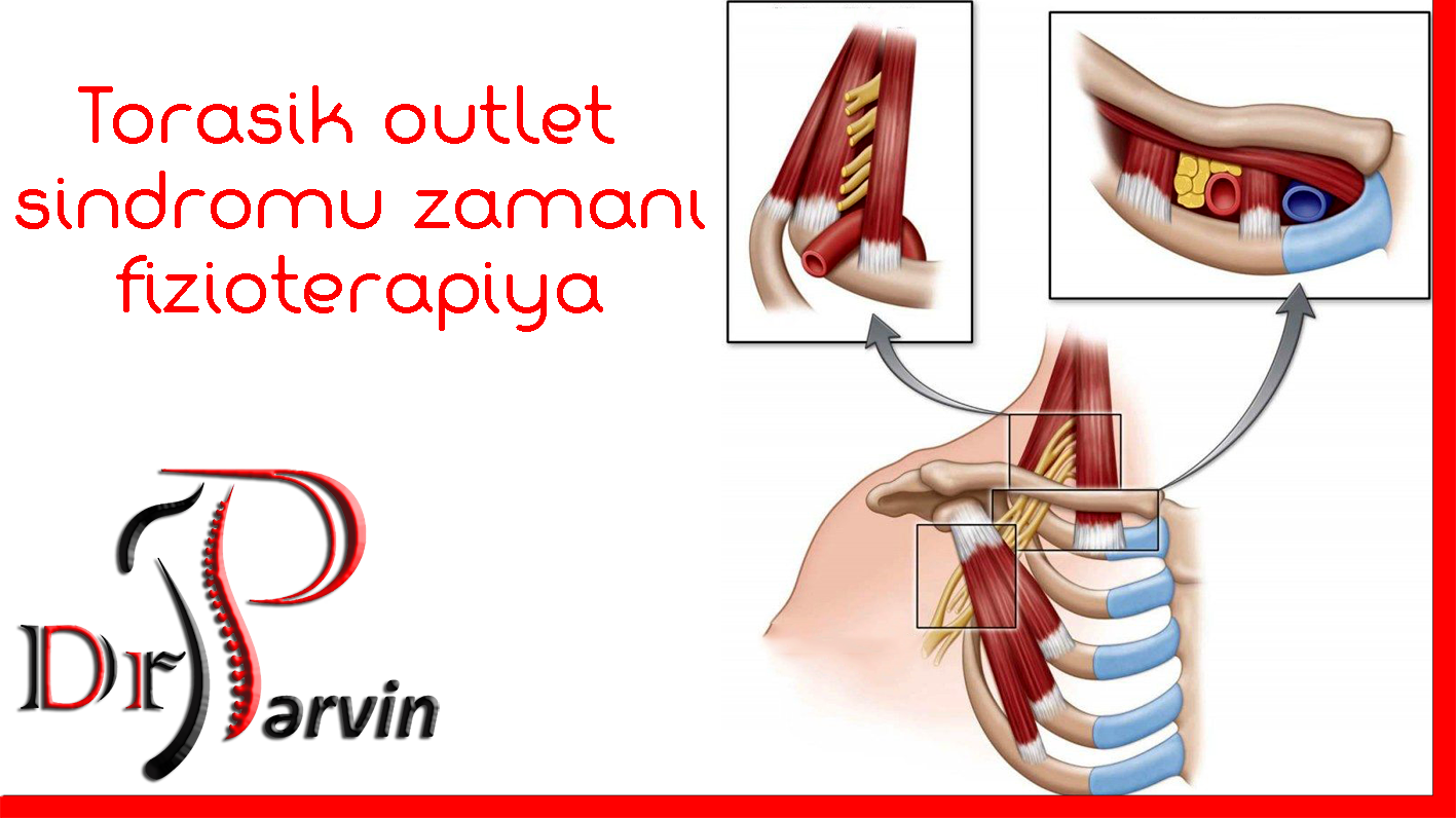 Dr.Parvin Akbarov - Torasik outlet sindromu zamanı fizioterapiya ...