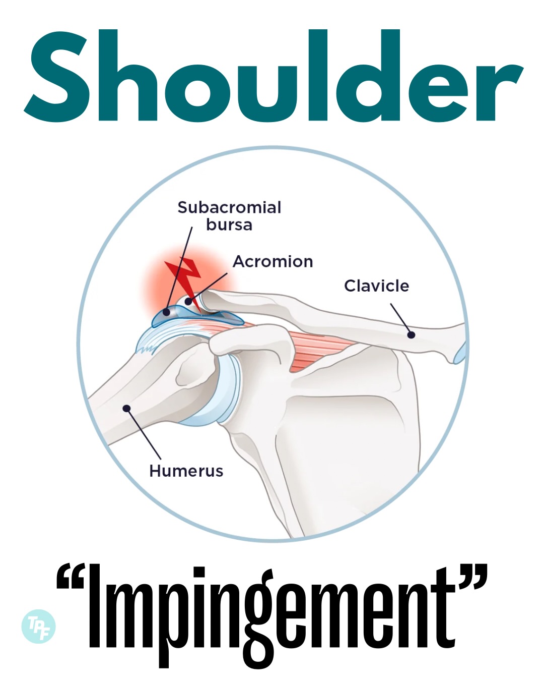 bpc 157 shoulder impingement 🚨Shoulder “Impingement” Rehab 🚨 💥This used to be called “subacromial impingement”, but now we use the term Subacromial Pain Syndrome (SAPS)- a fancy way of saying the pain is arising from something Fat Metabolism size:5mg*10vials Bacteriostatic Water 10 ml