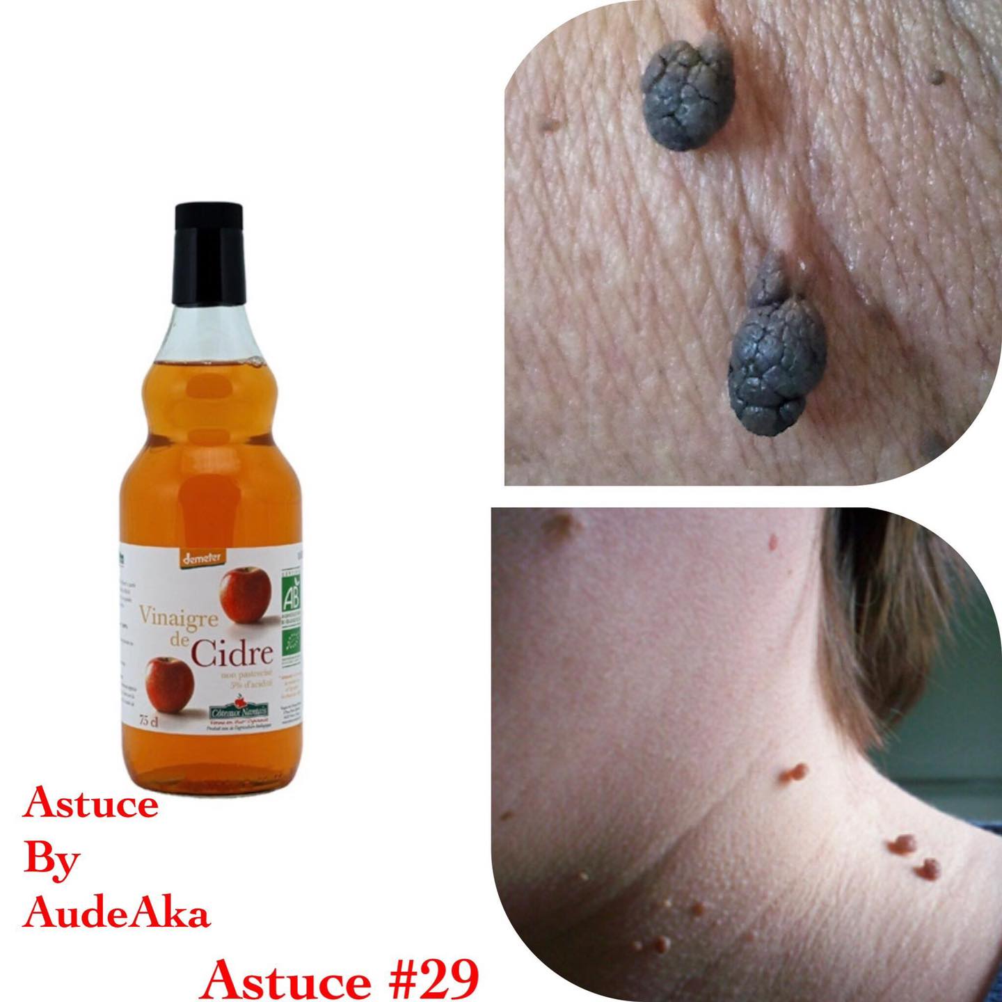 Acrochordon Vinaigre De Cidre Avis