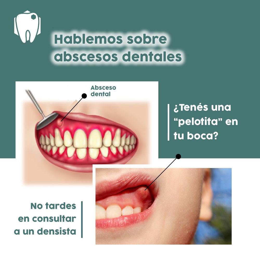 Dental.Pel - 🦷 ¿Qué debemos saber sobre los abscesos dentales? ️ Un ...