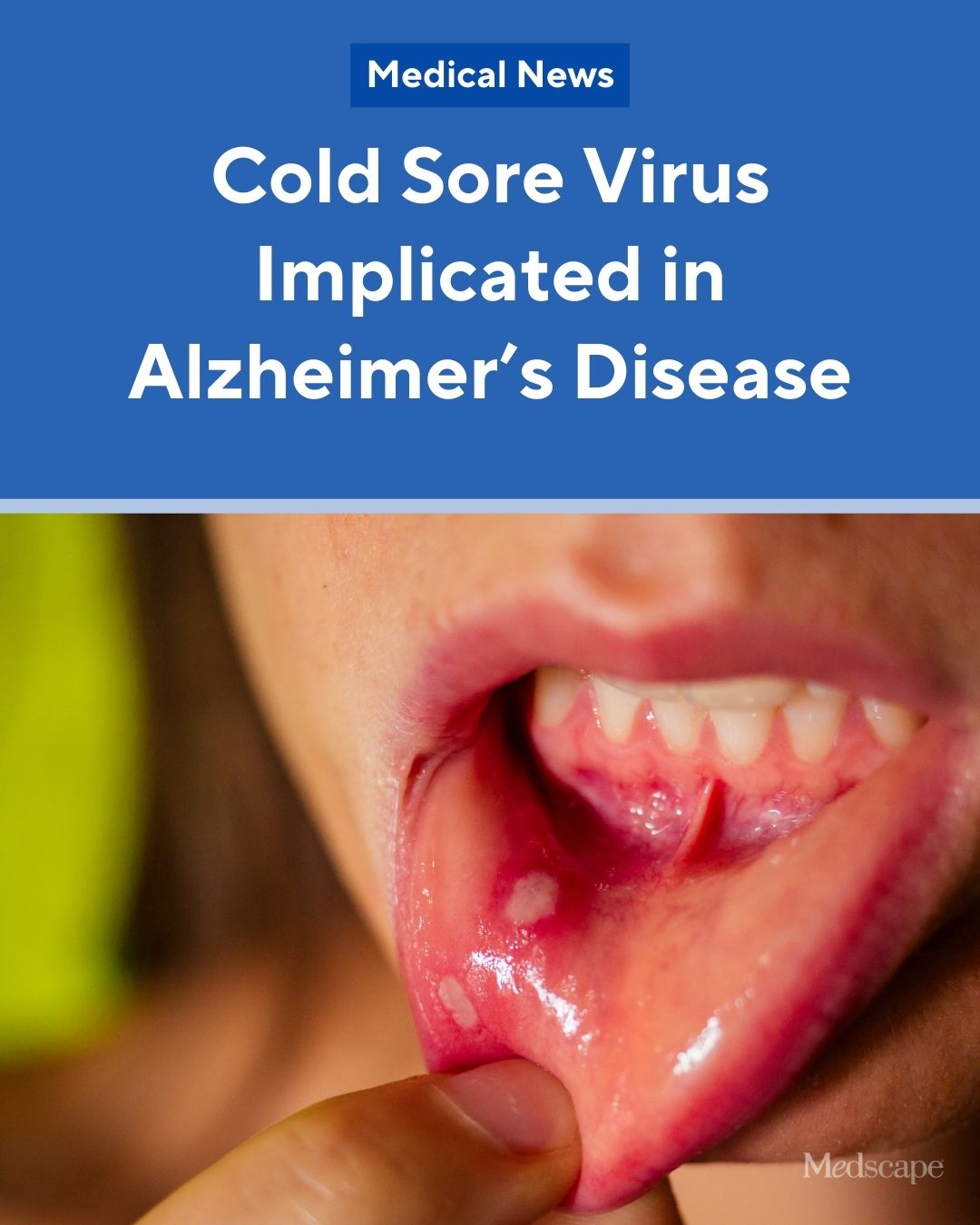 Medscape - HSV-1 infection may be linked to the risk for Alzheimer's disease, but antiviral treatment may be protective, a large case-control study suggests: http://ms.spr.ly/6185S5DQR