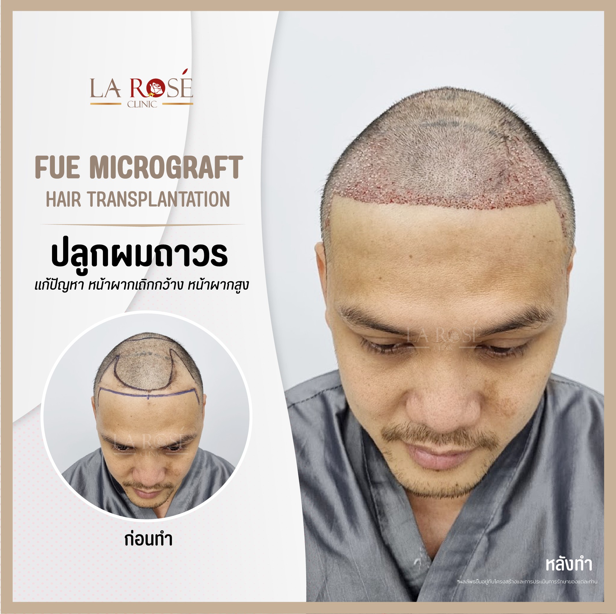 ป... - Larose Clinic Hair Center ปลูกผมถาวร FUE Micrograft DHI