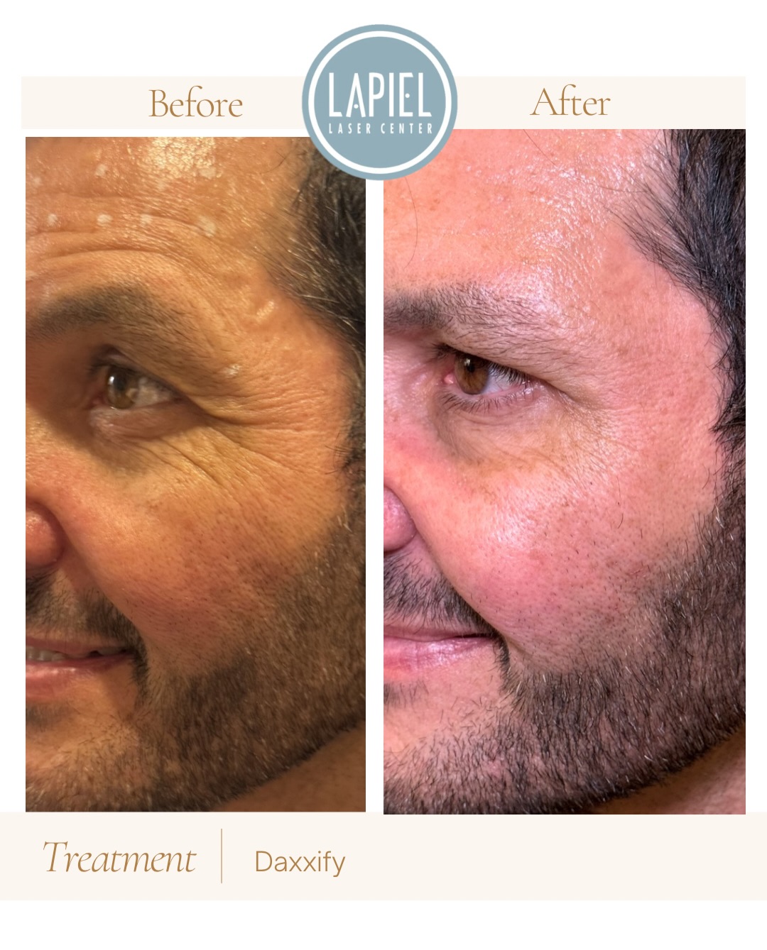 Lapiel Laser Center | Chicago IL