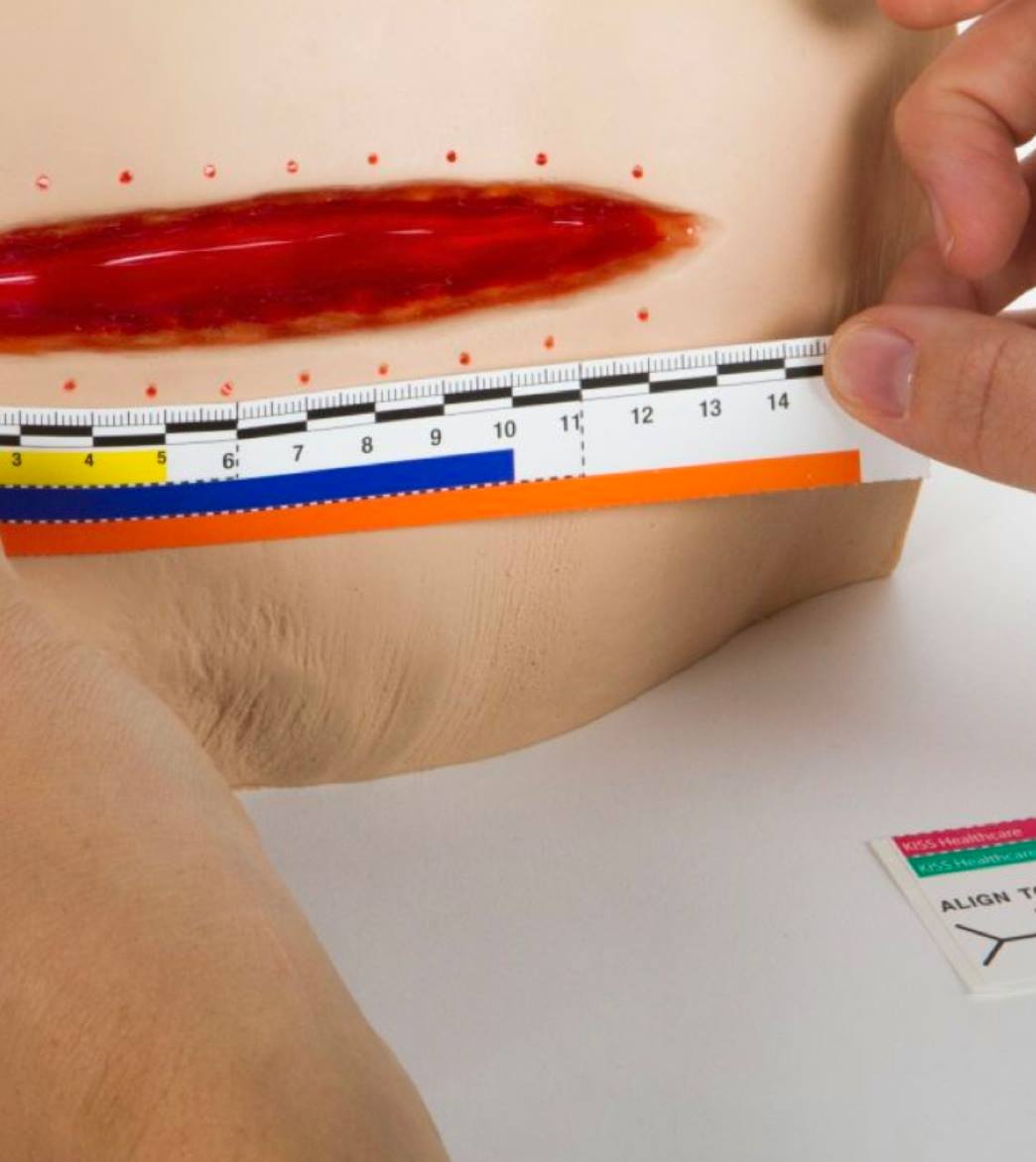 Kiss Healthcare - The KISS System wound ruler is an... | Facebook