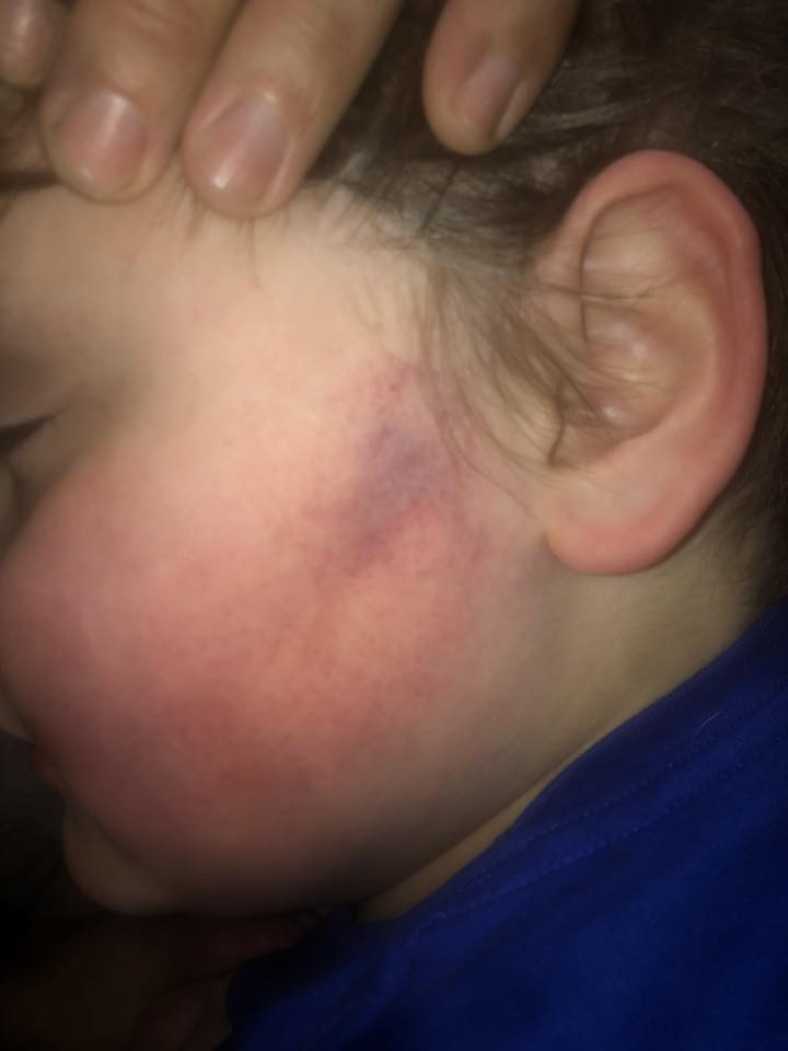 Should I report the bruise to my son's special education school?
