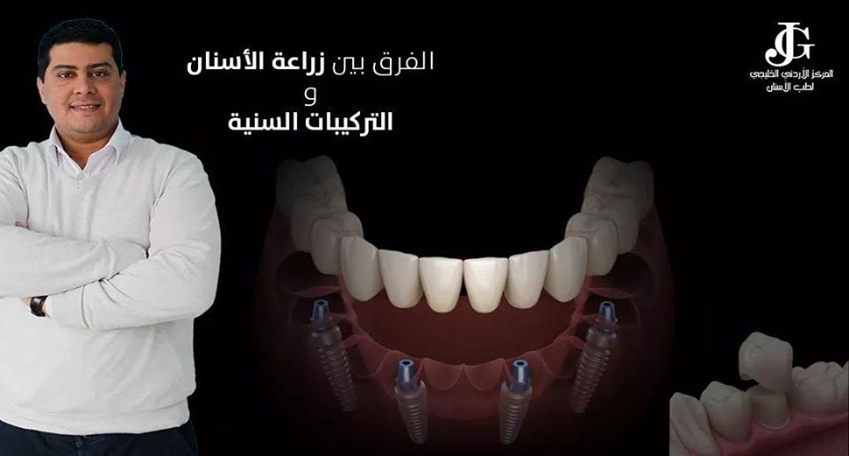 المركز الأردني الخليجي لطب الأسنان Jordanian Gulf Dental Clinic الفرق ما بين زراعة الأسنان و التركيبات الثابتة زراعة الأسنان يتم تعويض السن او الضرس المفقود فقط دون المساس بالاسنان او الضروس الاخرى حيث