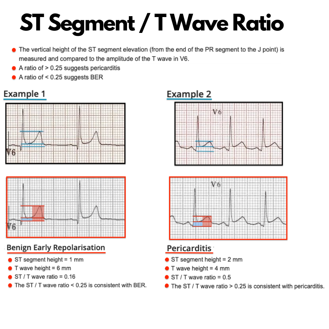 EKG Central - 🔰 ST Segment / T Wave Ratio 🔰 Struggling...