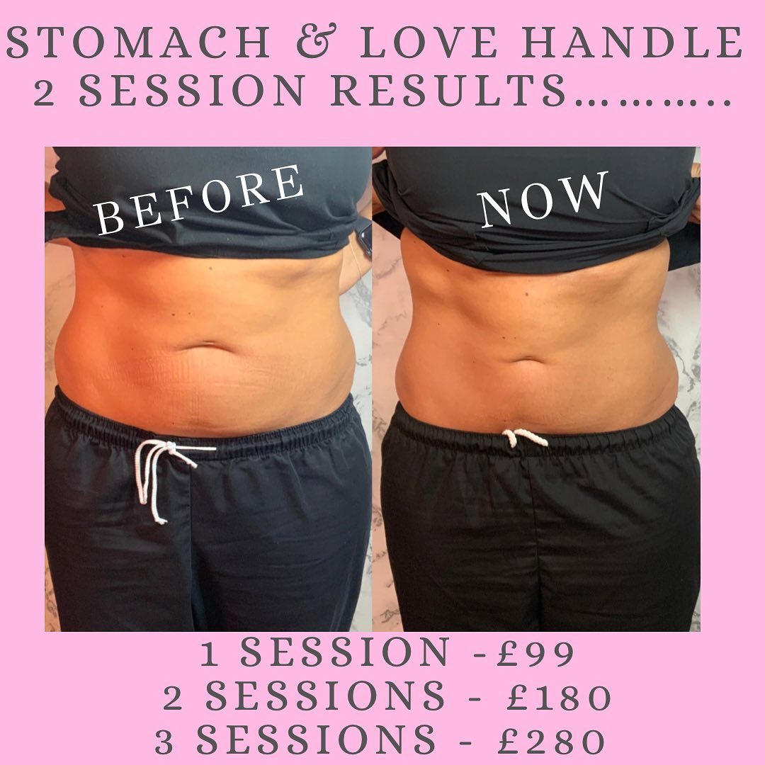 lemon bottle fat dissolving stomach 3 Sessions of dissolve? 𝐂𝐨𝐦𝐢𝐧𝐠 𝐫𝐢𝐠𝐡𝐭 𝐮𝐩... 😍 Ummm sorry but look at these results.. one of my favourite treatments so many of my clients are amazed with their L-CarnItine 250 mg Capsules Fragrance:Lavender Vanilla Your skin's natural GHK-Cu