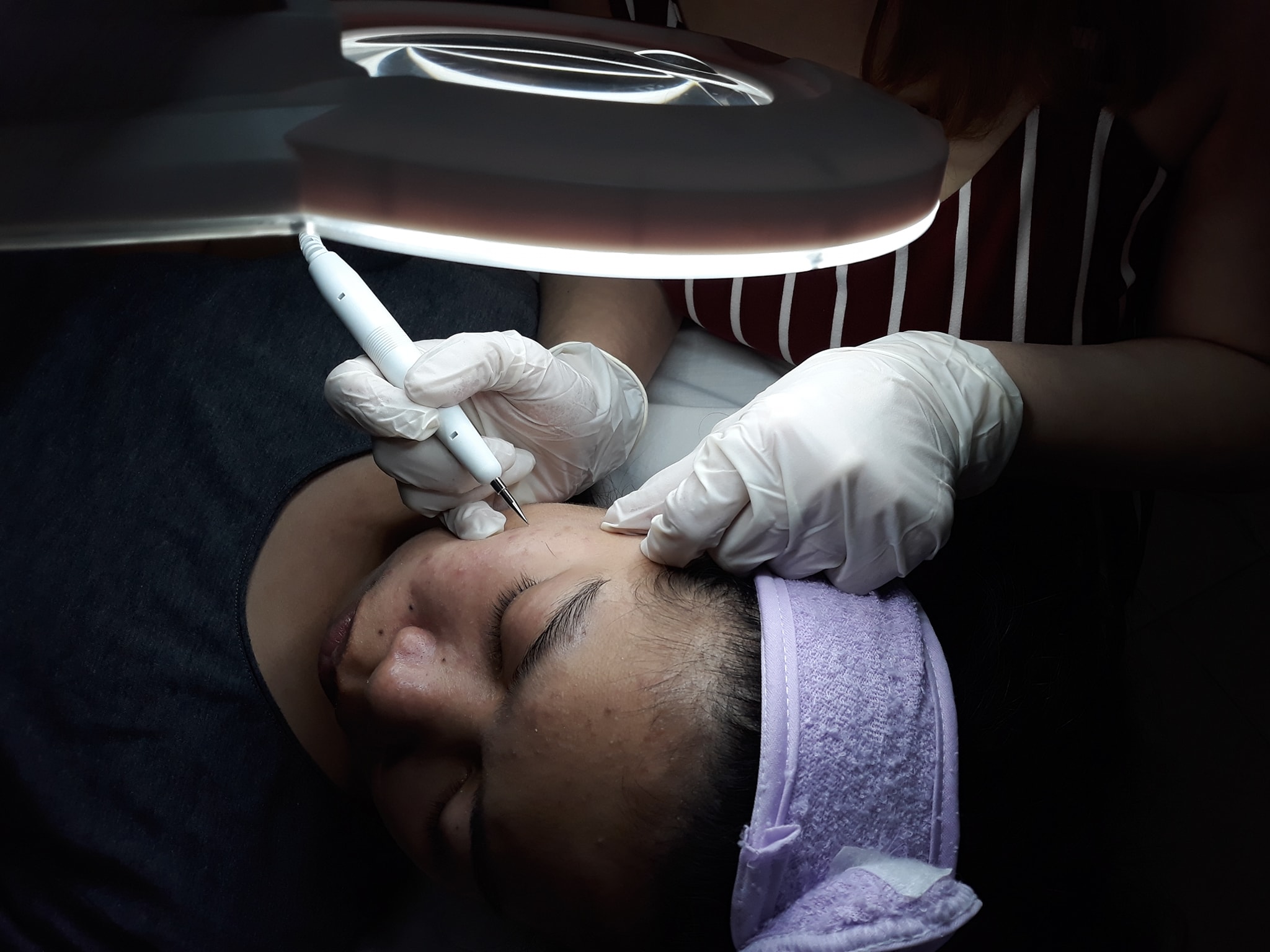 Painless Warts Removal @Calayan... - Calayan Skin Clinic | Facebook