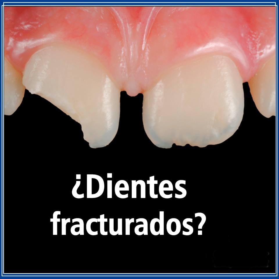 Los dientes astillados o rotos son unas de las emergencias dentales más ...