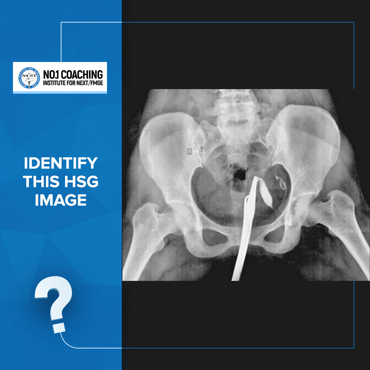 Bicornuate Uterus Hsg Diagnostic Value Of Hysterosalpingography In The