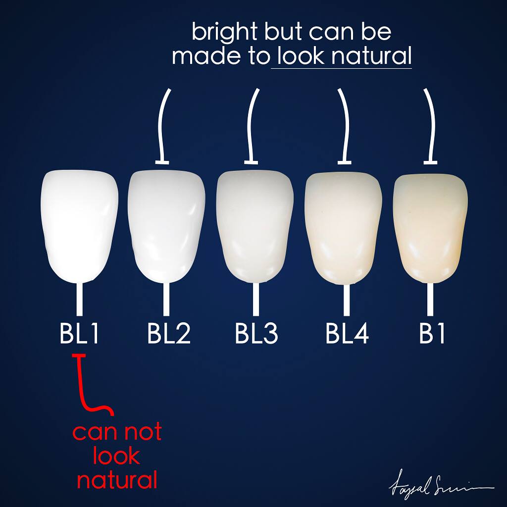 Ceramic Veneers Can Be Made In A Dr Faysal Succaria Facebook