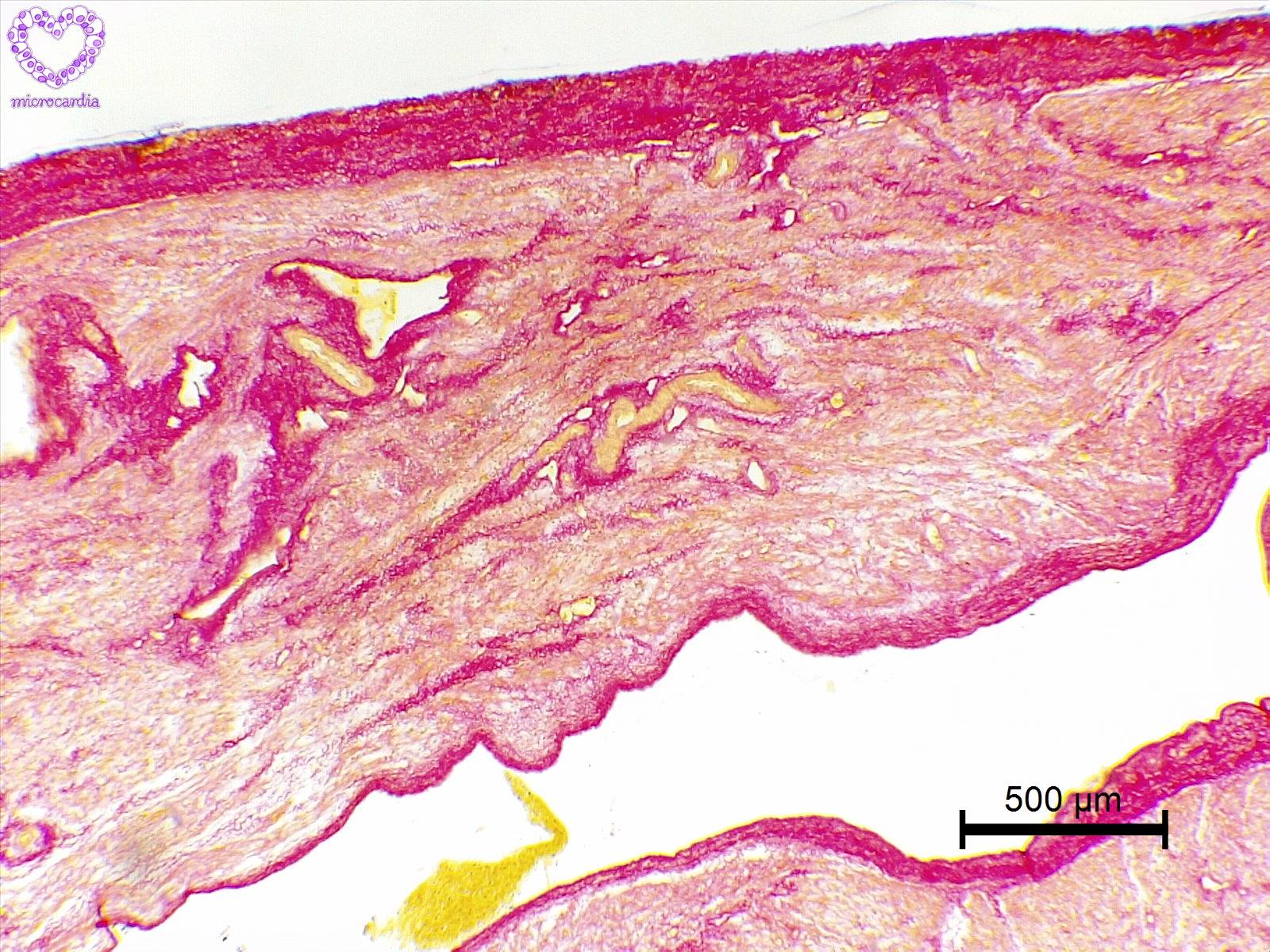 Microcardia