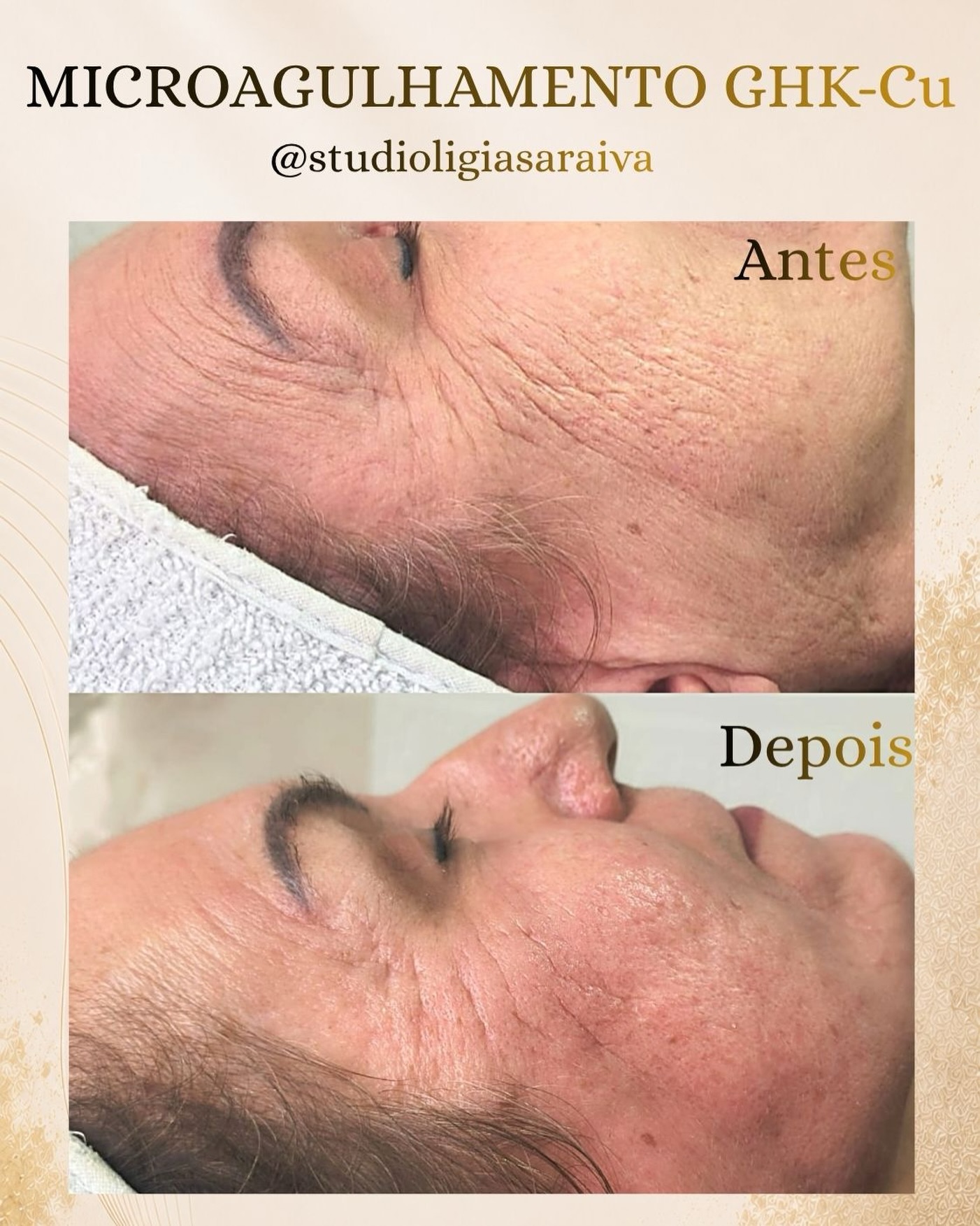 bollywood glutathione before and after celebrity The itch to go for skin lightening in : r/BollyBlindsNGossip bollywood glutathione before and after badge: Best Seller Net Weight:500mcg bpc 157 and crohn's