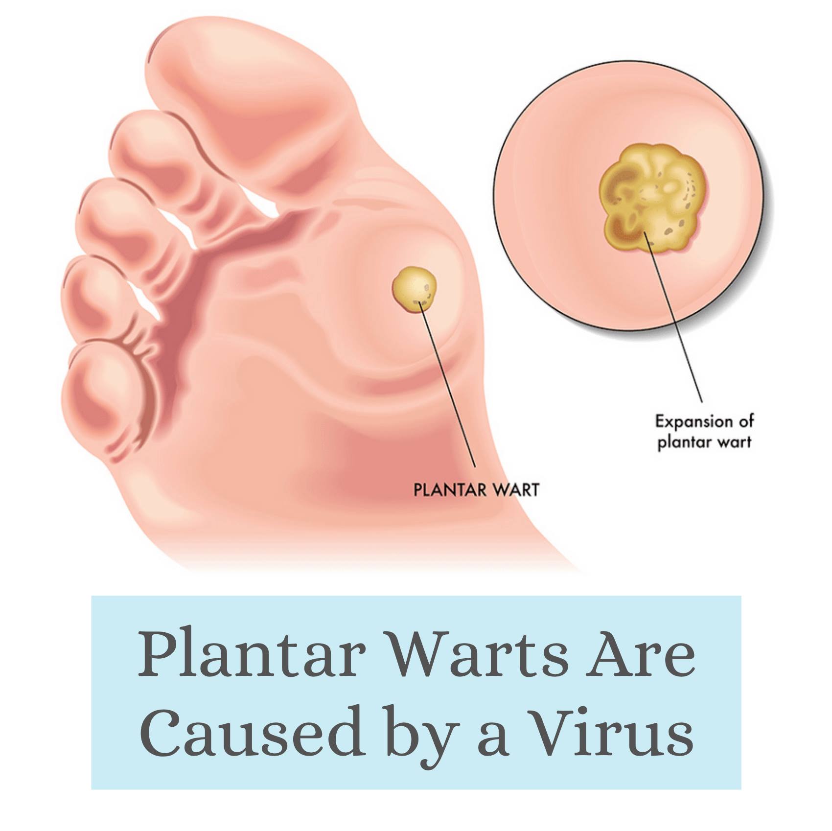 Wigley FEET - ️ Plantar warts develop on the bottom of... | Facebook