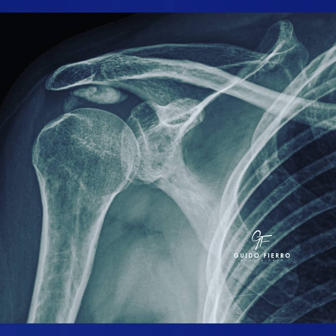 TENDINITIS CALCIFICANTE DEL... - Cirugía de Hombro y Codo