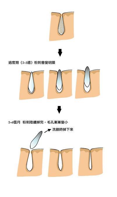 輕鬆美膚 最近很多粉絲 紛紛寫信來詢問 到底抗痘組合要用多久 才可以看到效果 首先 陳皮靠腰 都一定根據皮膚醫學正常的生理病理來說明 一定不會說出一些違背皮膚醫學的說法 那種什麼一個月內就沒有毛孔的廣告詞請當笑話看看就好 這個問題 其實是一個個別差異