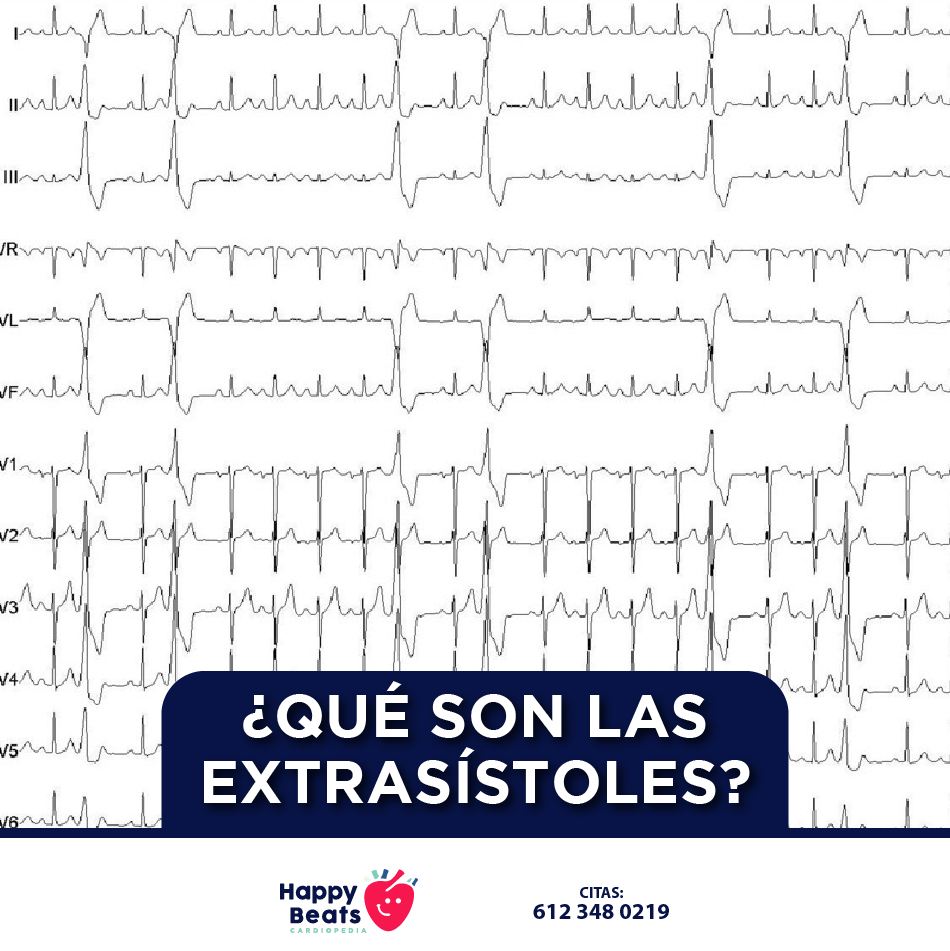 Las EXTRASÍSTOLES, son una... - Happy Beats - Cardiopedia