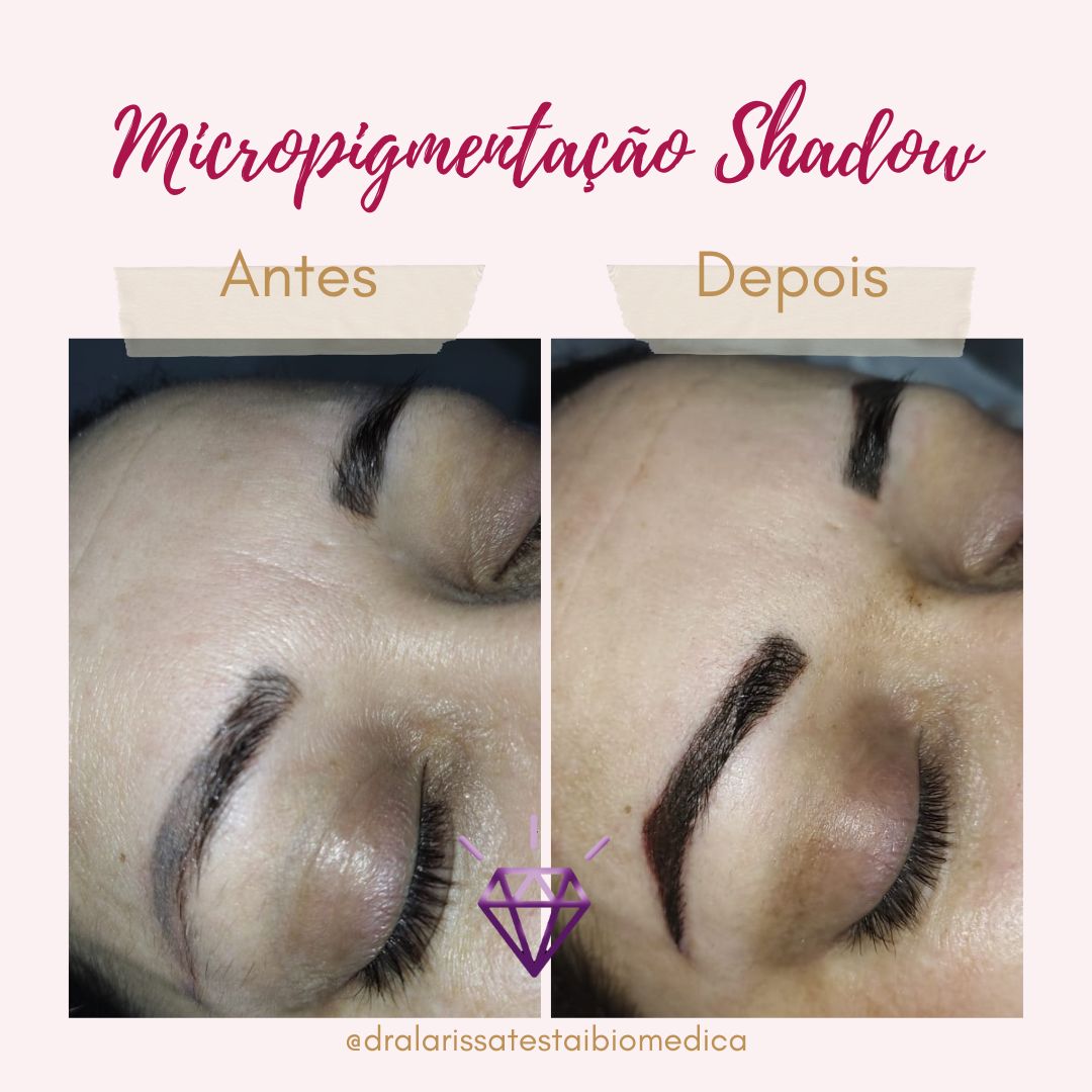 💎 ANTES E DEPOIS INCRÍVEL #micro... - Dra. Larissa Testai